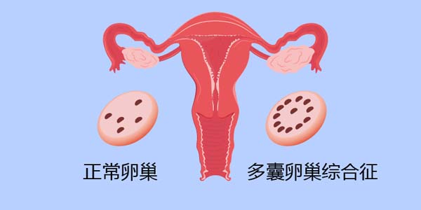 卵巢囊肿是什么原因引起的